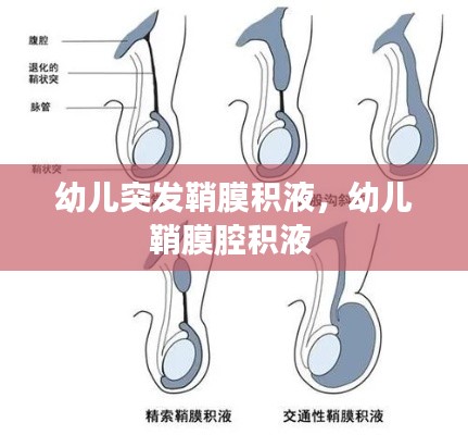 幼儿突发鞘膜积液,幼儿鞘膜腔积液